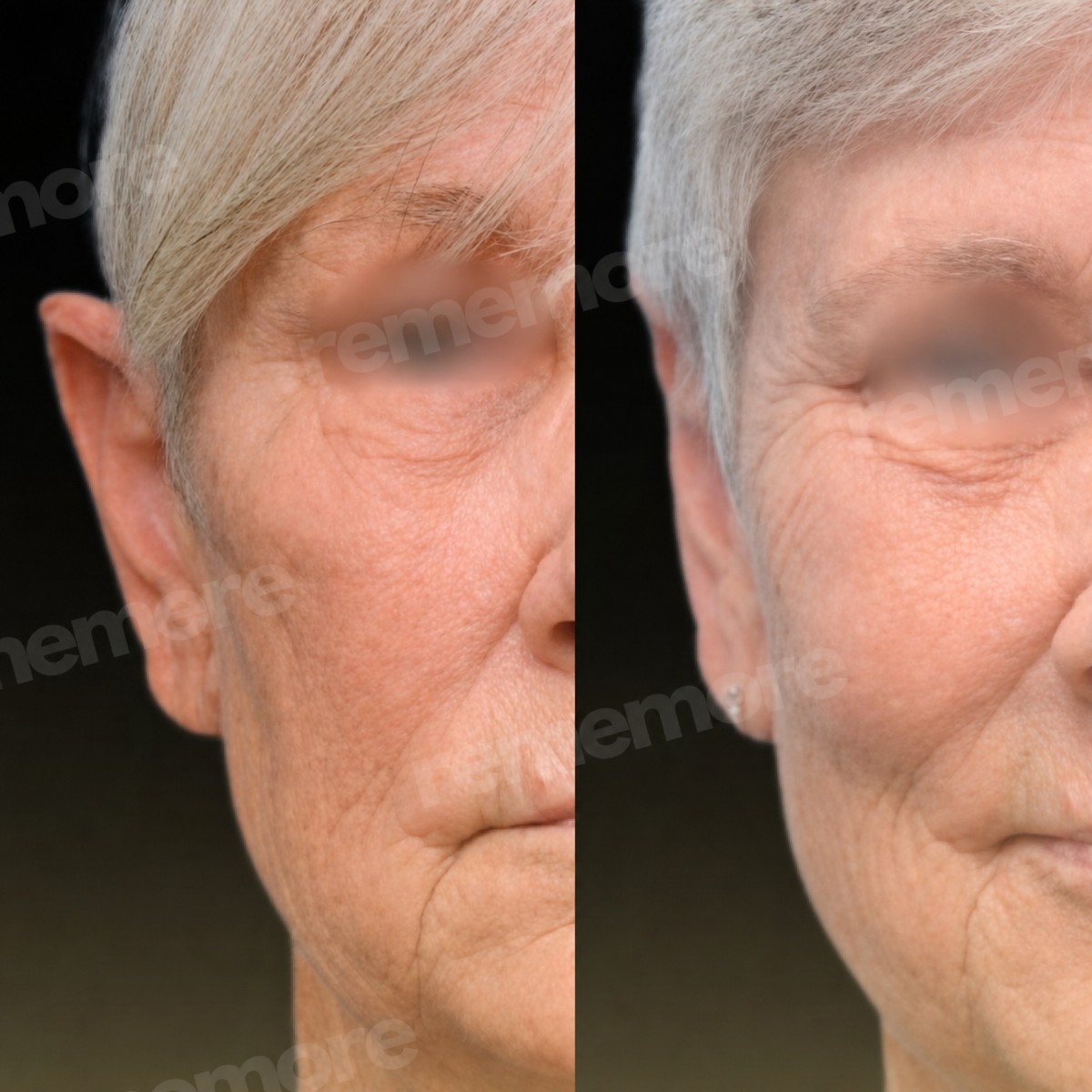 نتائج تجميل الأذن قبل وبعد في مستشفى ميموريال أنطاليا، تحسين شكل الأذن