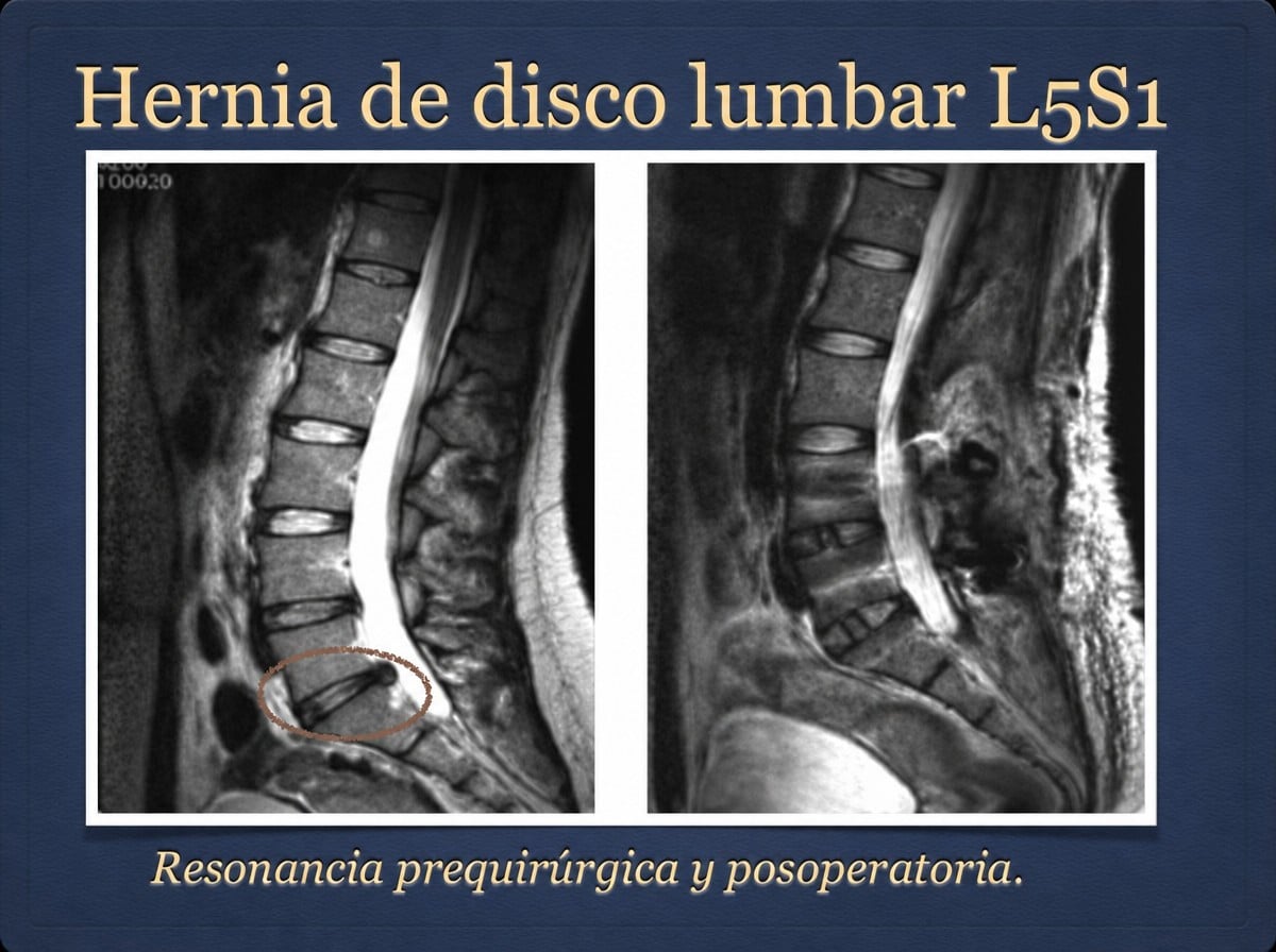 Resultados antes y después de discectomía lumbar en GDL High Specialty Neurosurgery
