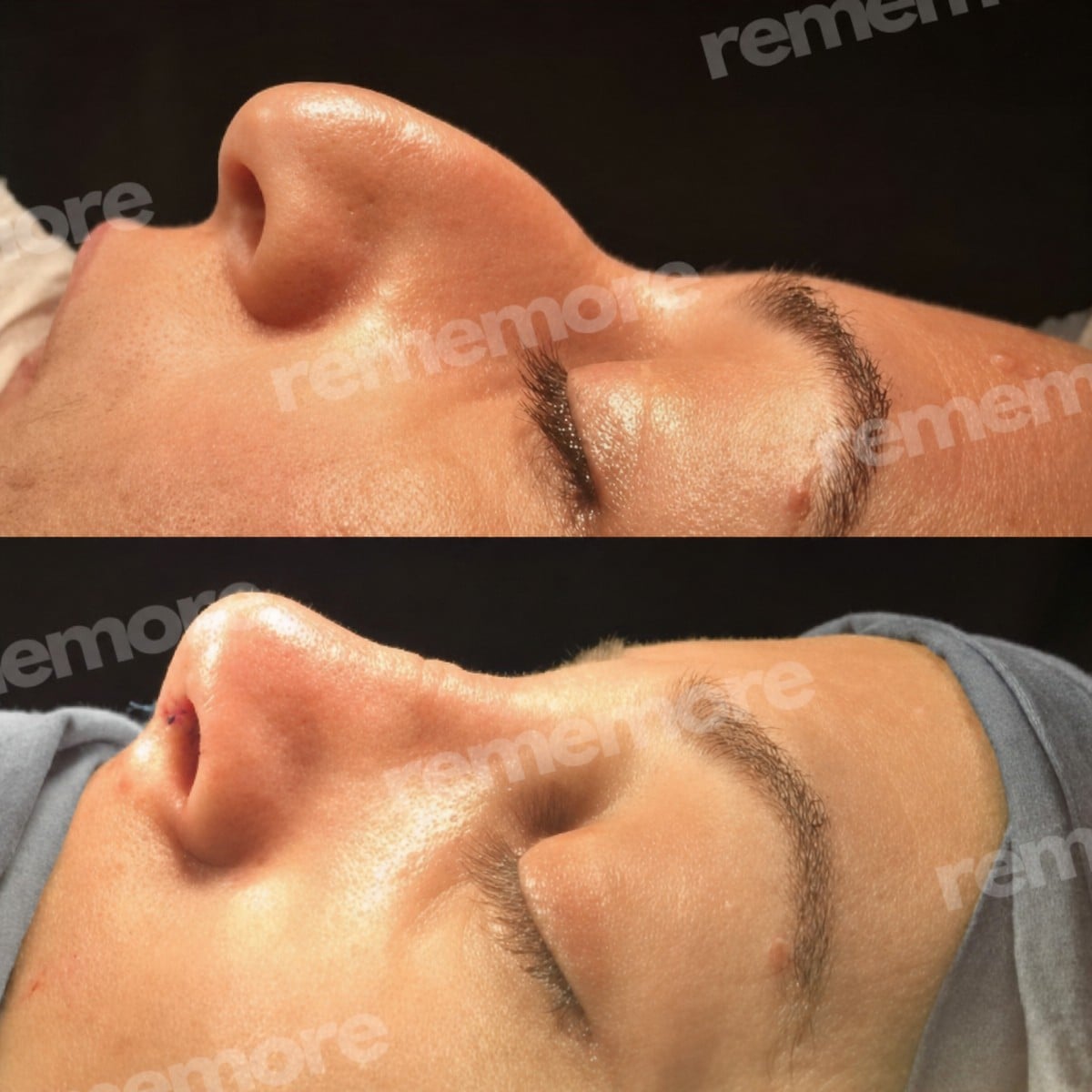 Resultados antes y después de rinoplastia abierta en Memorial Şişli Hospital, forma de nariz mejorada