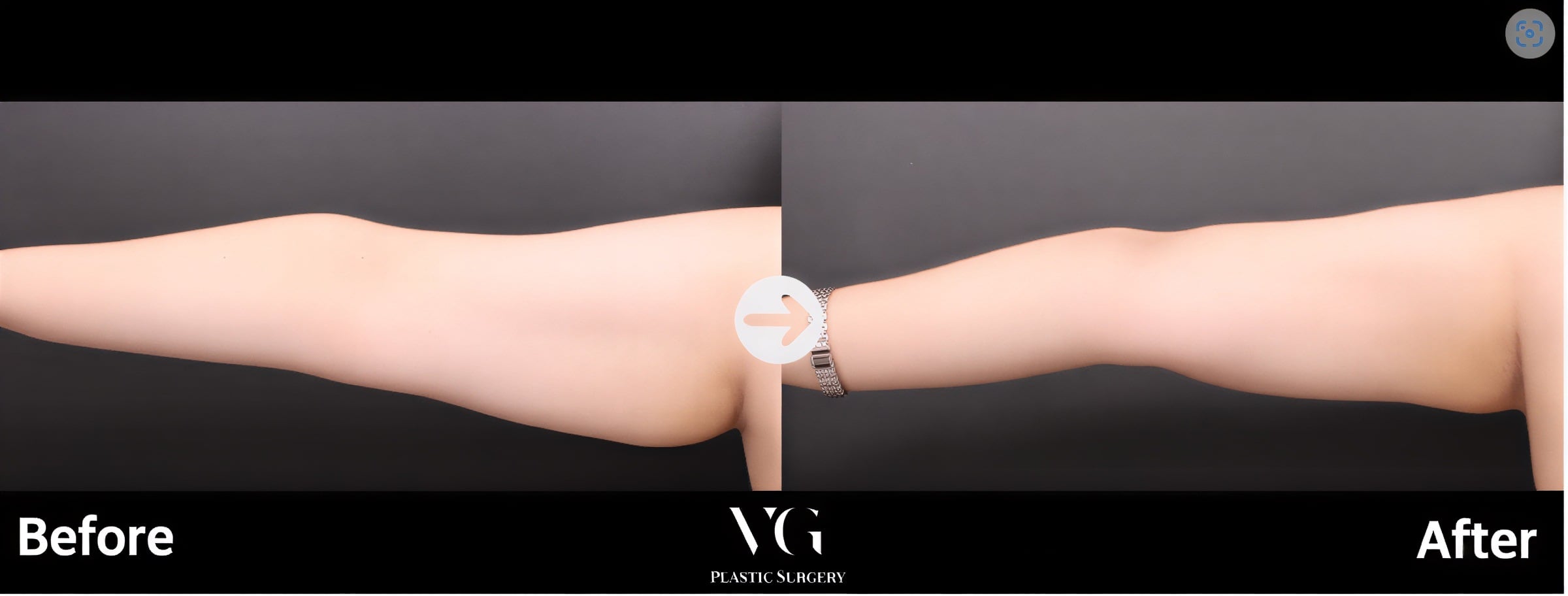 Resultados de liposucción de brazos antes y después en VG Plastic Surgery – brazo más delgado