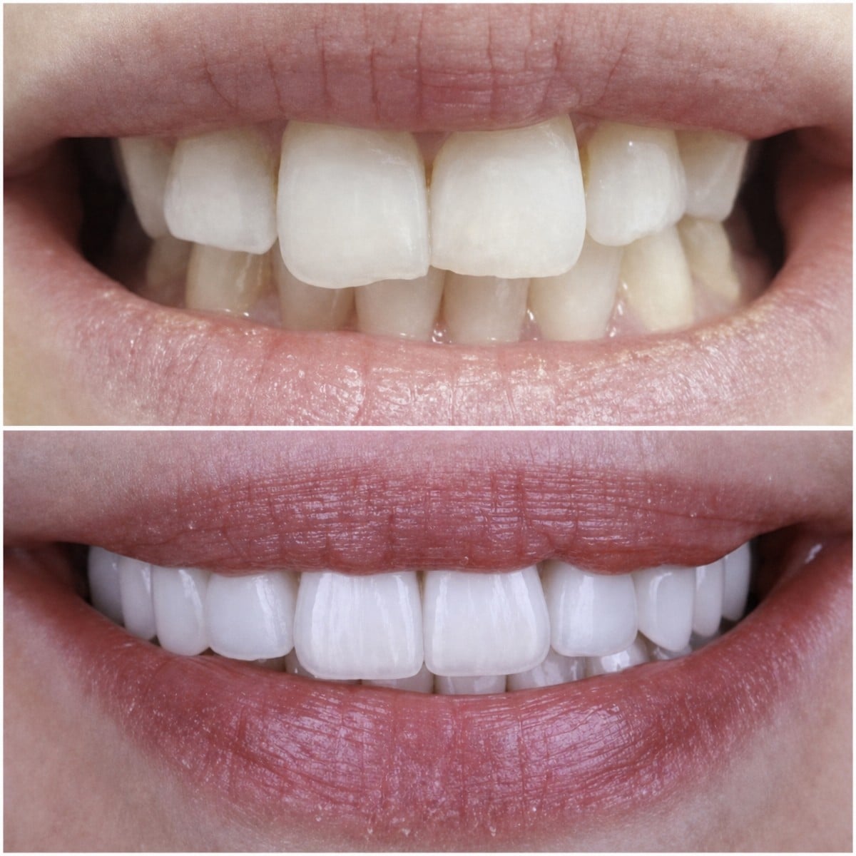 Resultado antes y después de carillas en Sciedece Scientific Center for Dentistry and Ultrasound Surgery