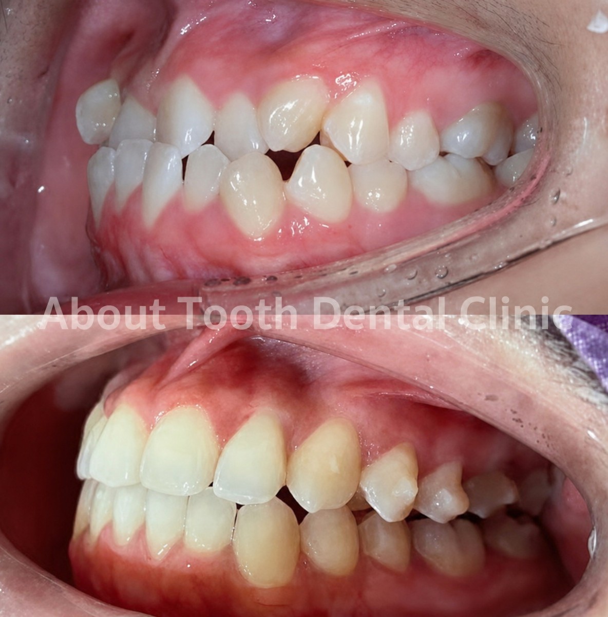 نتائج قبل وبعد تقويم Invisalign في About Tooth Dental Clinic – تحسين انتظام الأسنان