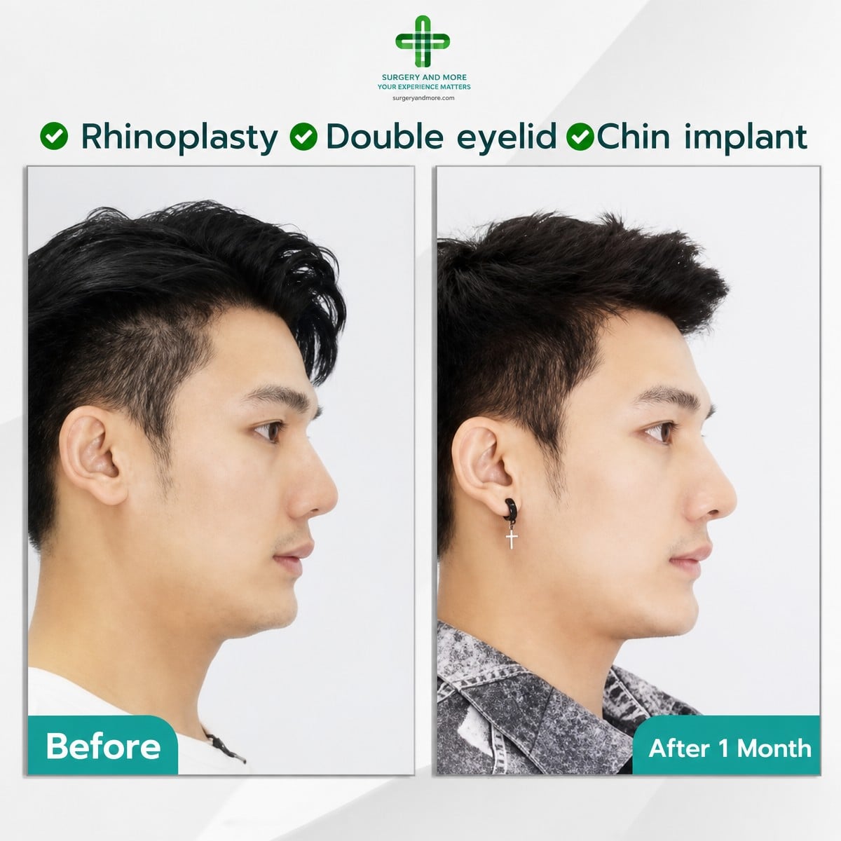 Resultados antes y después de rinoplastia, doble párpado e implante de mentón en Intrarat Hospital
