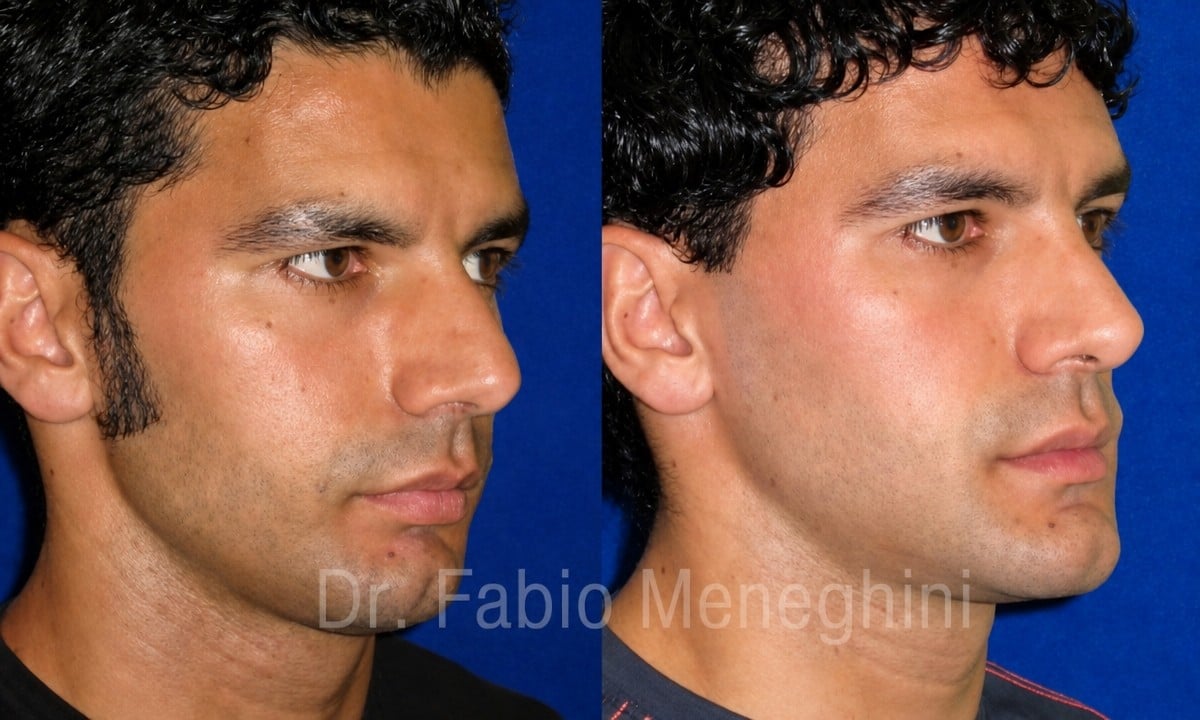 نتائج تجميل الأنف قبل وبعد في مستشفى ماريا سيسيليا، تحسين شكل الأنف للرجال