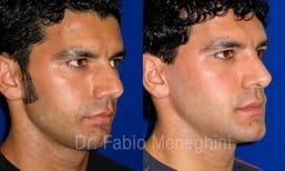 نتائج تجميل الأنف قبل وبعد في مستشفى ماريا سيسيليا، تحسين شكل الأنف للرجال