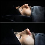 Resultados de rinoplastia antes y después en Biruni University Hospital, perfil nasal mejorado