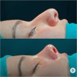 نتائج تجميل الأنف قبل وبعد في مستشفى بيروني الجامعي، إعادة تشكيل الأنف