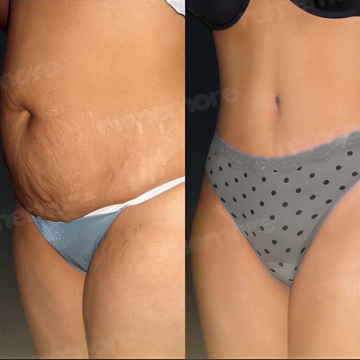 Resultados de lipoescultura 360 antes y después en Memorial Şişli Hospital, mejor contorno corporal