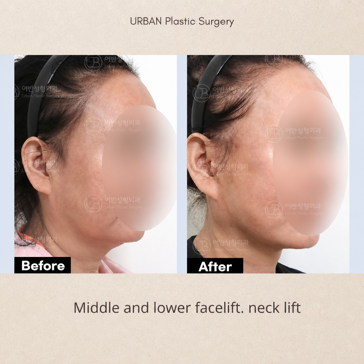نتائج شد الرقبة والوجه قبل وبعد في URBAN Plastic Surgery وتحسن واضح في تحديد الملامح
