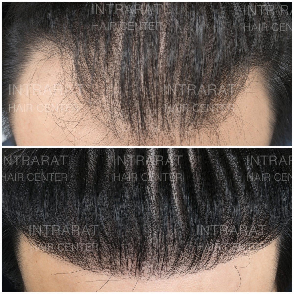نتائج زراعة الشعر FUT قبل وبعد في مستشفى إنترارات، كثافة خط الشعر المحسنة