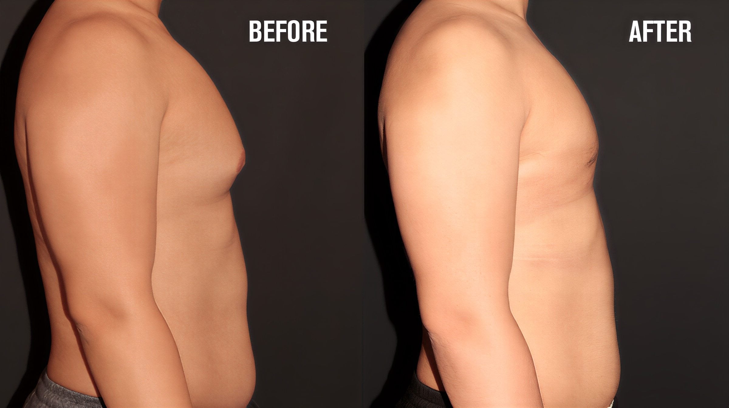 Resultados antes y después de liposucción Vaser para ginecomastia en Quartz Hospital, contorno de pecho