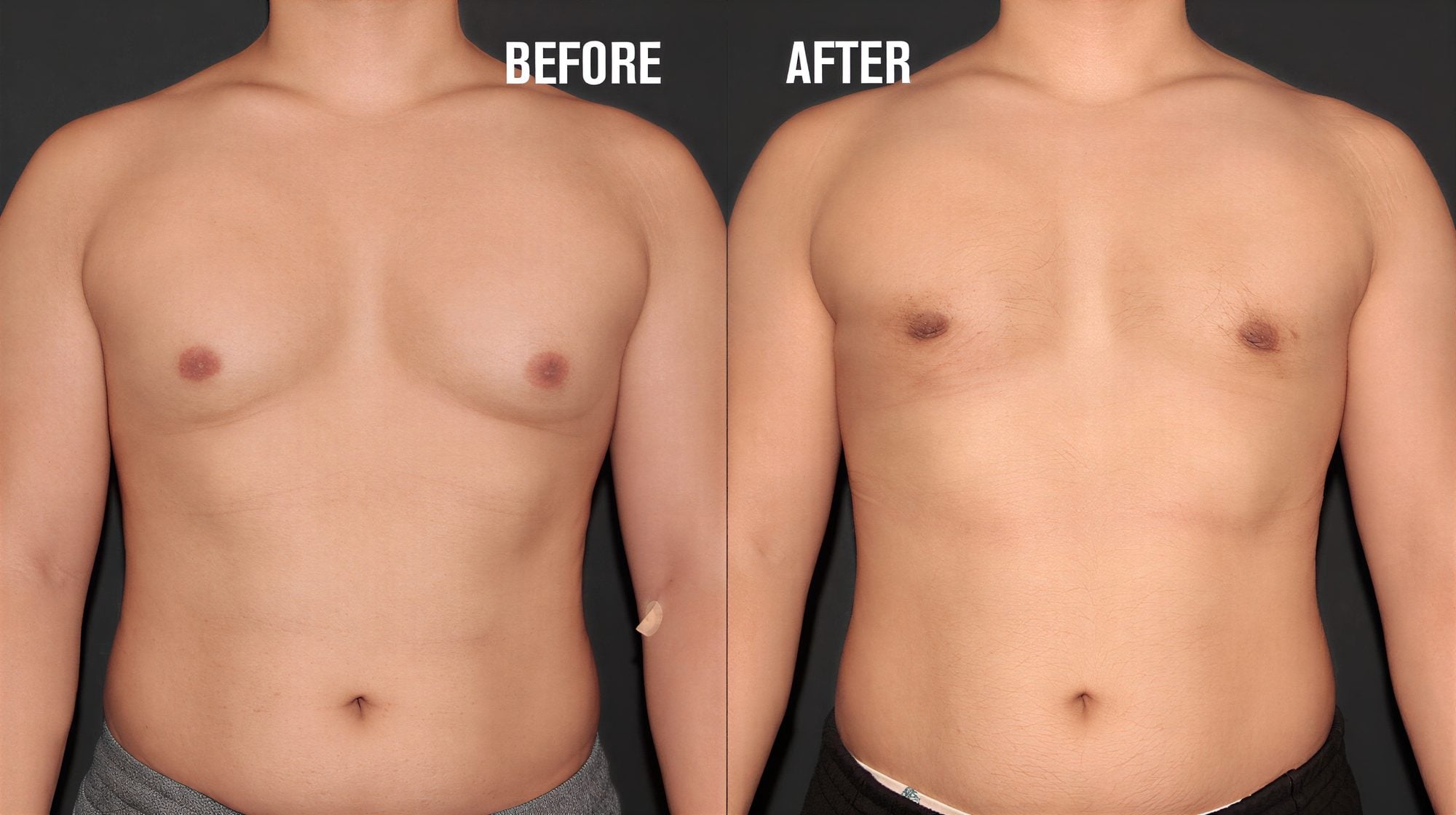 Resultados antes y después de liposucción Vaser para ginecomastia en Quartz Hospital, contorno de pecho