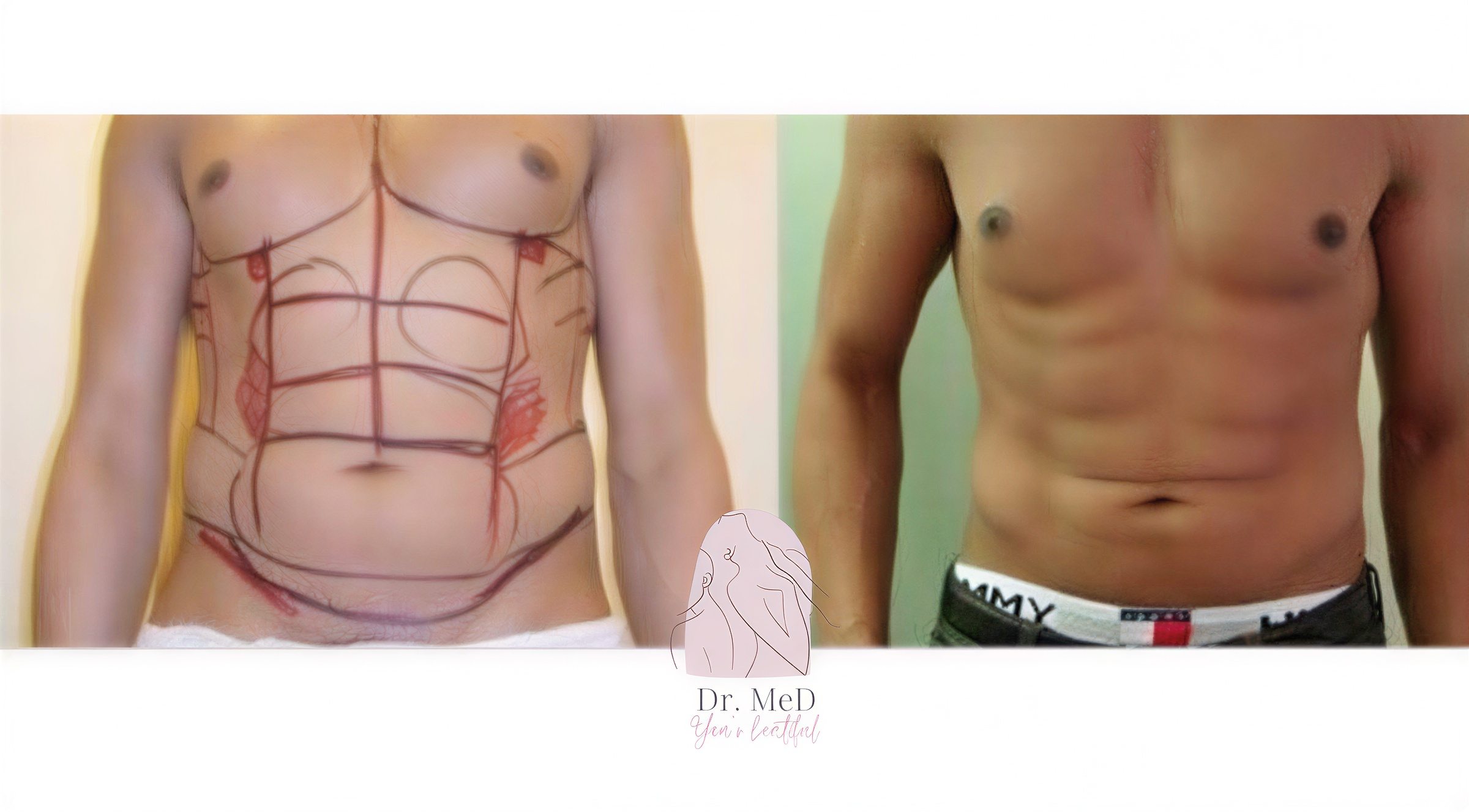 Resultados antes y después de liposucción Vaser en Dr. MED, mejora visible del abdomen