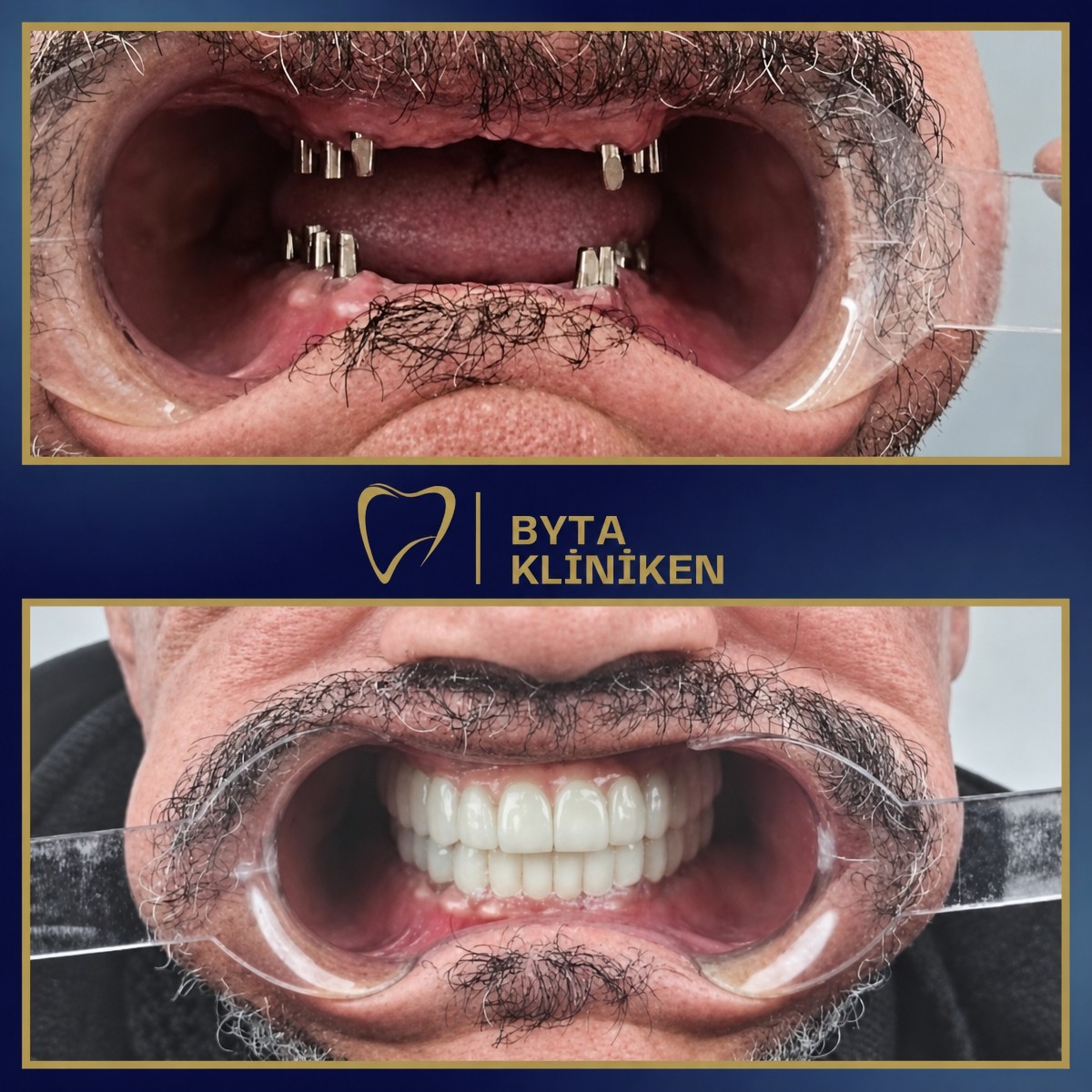 Resultado antes y después de implantes dentales All-on-4 en KLİNİKEN, sonrisa restaurada
