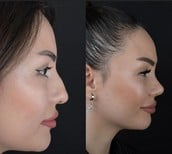 Resultados de rinoplastia antes y después en Büyük Anadolu Hospitals (BAH), perfil nasal mejorado