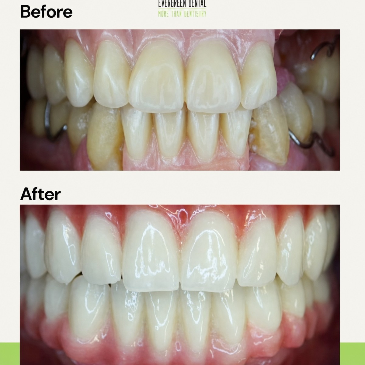نتائج قبل وبعد طقم الأسنان في عيادة Evergreen Dental – ابتسامة محسنة وأسنان أكثر بياضًا
