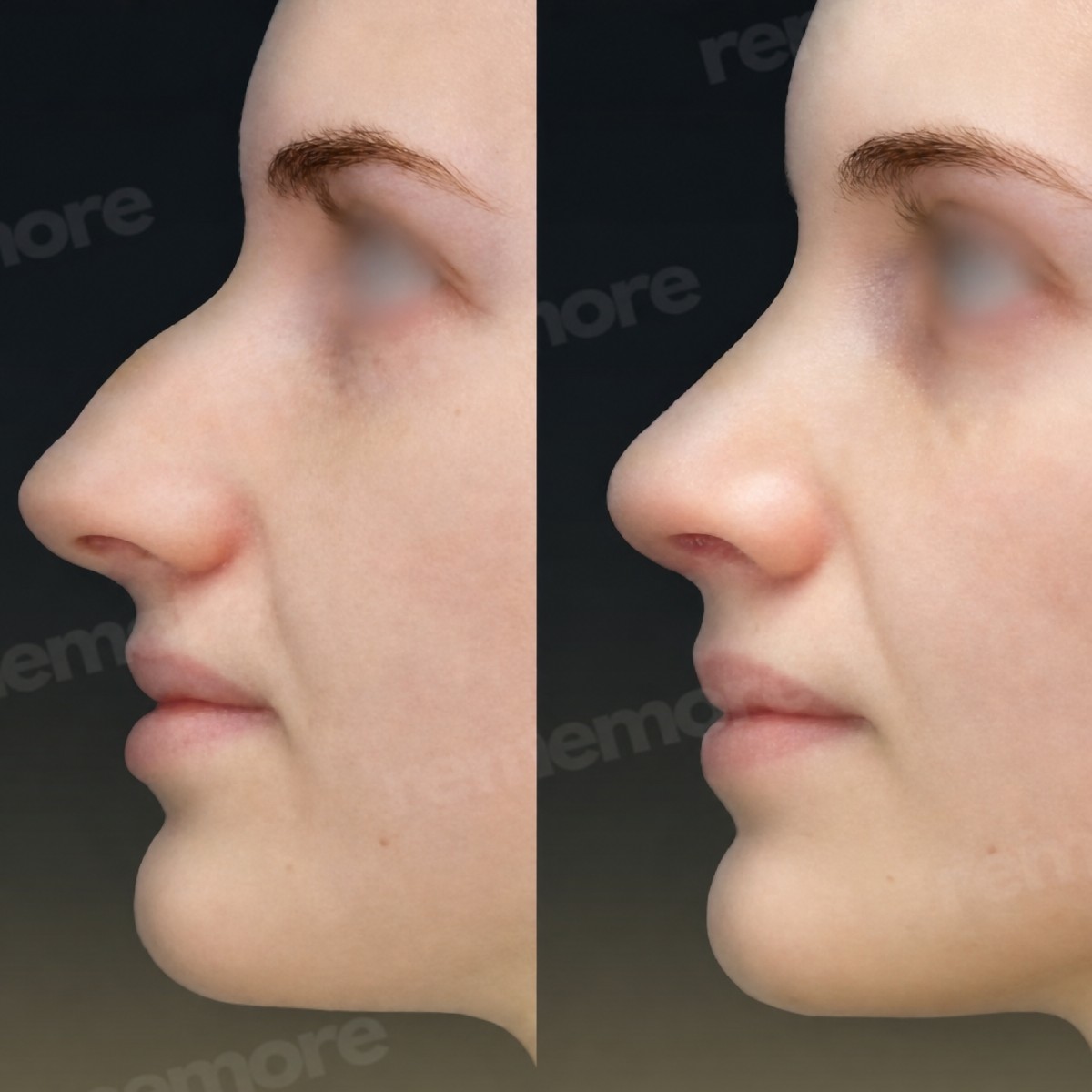 Resultados antes y después de septoplastia en Memorial Ankara Hospital, perfil nasal mejorado