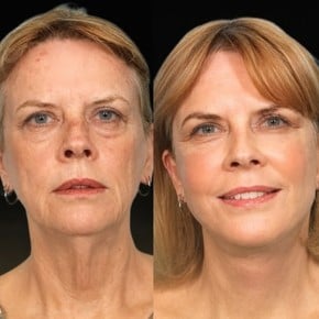 Facelift Vorher-Nachher-Ergebnisse im Memorial Bahçelievler Hospital, sichtbare Verjüngung