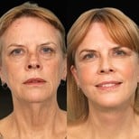 Facelift Vorher-Nachher-Ergebnisse im Memorial Bahçelievler Hospital, sichtbare Verjüngung