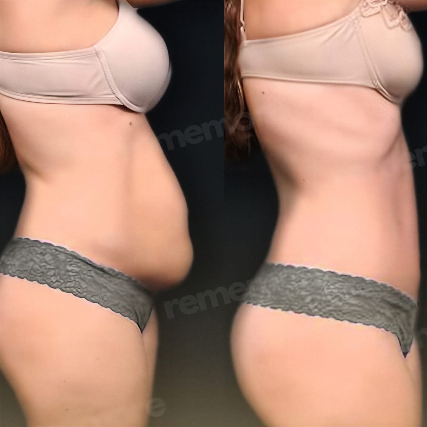 Resultados antes y después de mommy makeover en Memorial Bahçelievler Hospital, abdomen plano