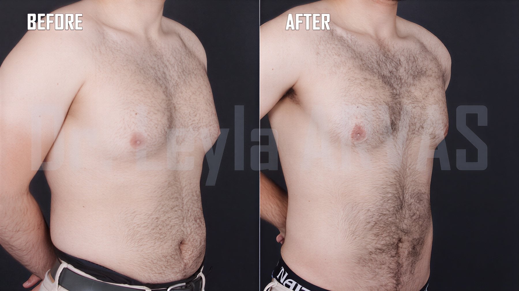 Resultados de Vaser liposucción antes y después en Quartz Hospital, contorno masculino