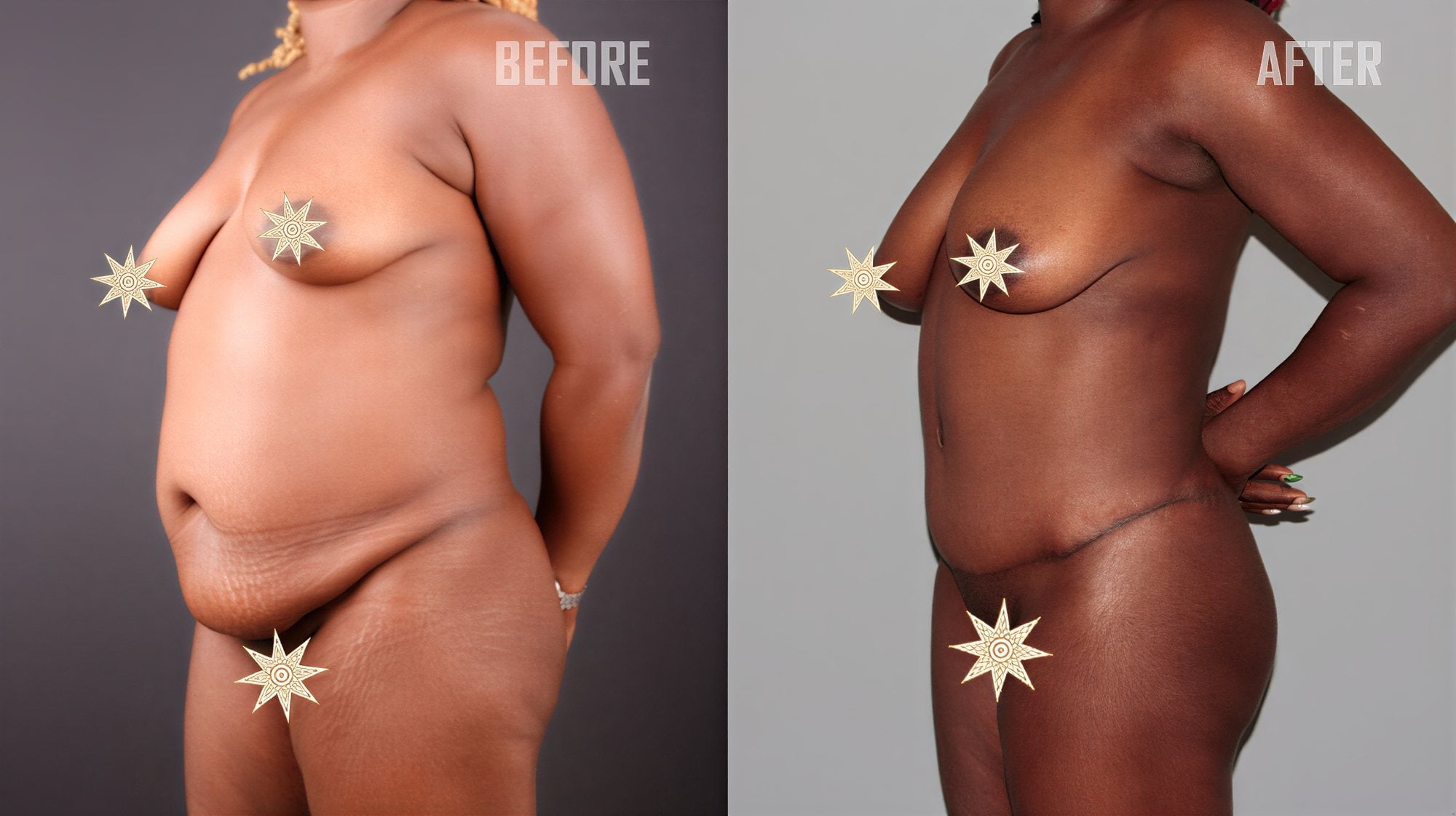 Antes y después de liposucción en Quartz Hospital, resultado visible de contorno corporal y reducción de grasa