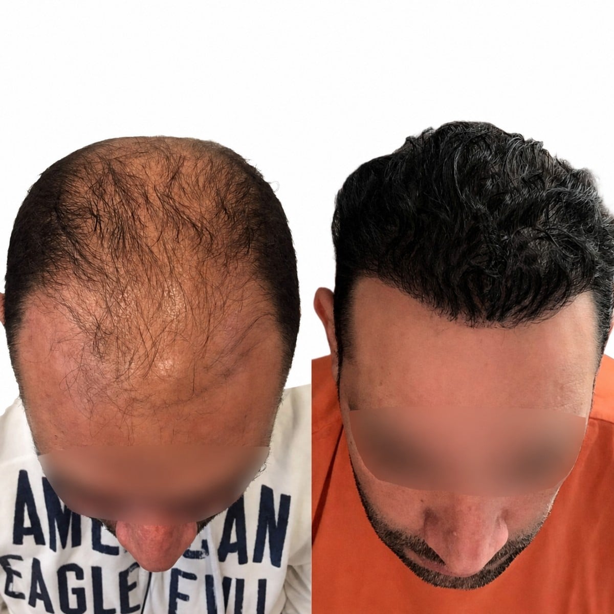 Resultados antes y después del trasplante capilar DHI en Adem and Havva Medical Center, línea restaurada