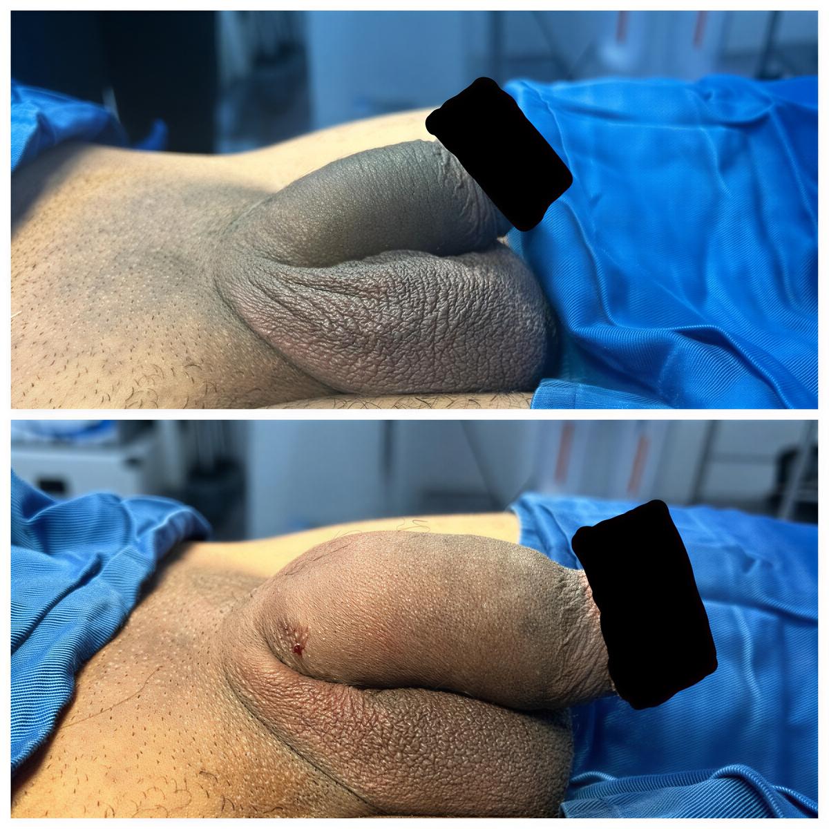نتائج قبل وبعد حقن الفيلر للعضو الذكري في Cosmesurgery Clinic – زيادة واضحة في السماكة