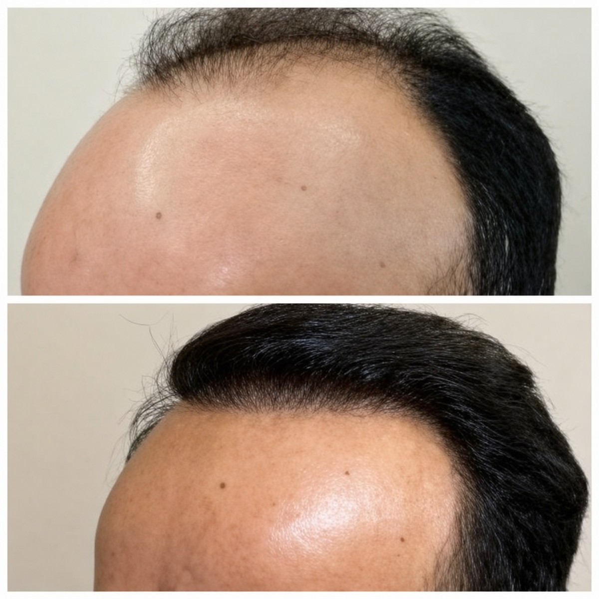 نتائج زراعة الشعر قبل وبعد في مستشفى برايفت ميديكابيل، استعادة خط الشعر