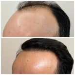 نتائج زراعة الشعر قبل وبعد في مستشفى برايفت ميديكابيل، استعادة خط الشعر