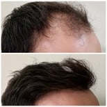 نتائج زراعة الشعر قبل وبعد في مستشفى برايفت ميديكابيل، استعادة خط الشعر