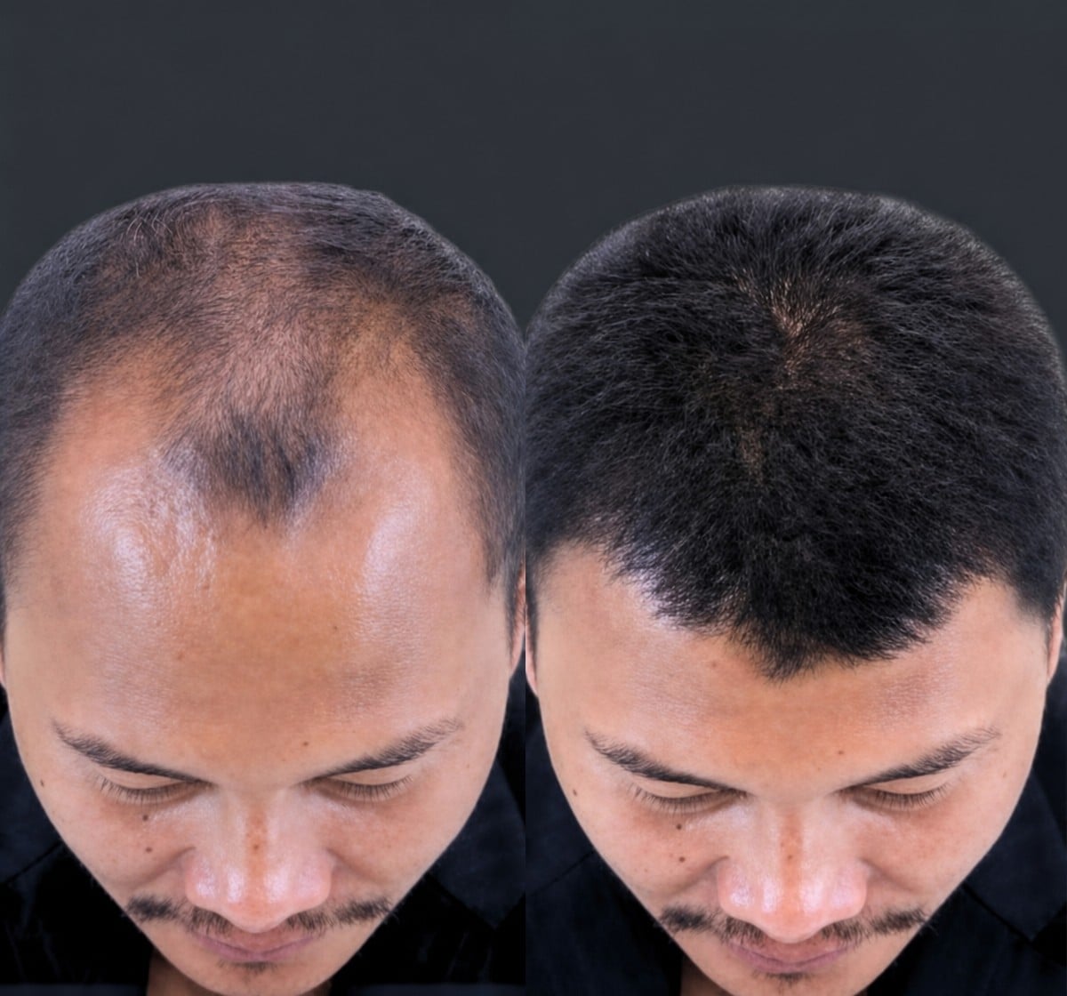 نتائج قبل وبعد زراعة الشعر DHI في مستشفى Memorial Bahçelievler، خط شعر أكثر كثافة