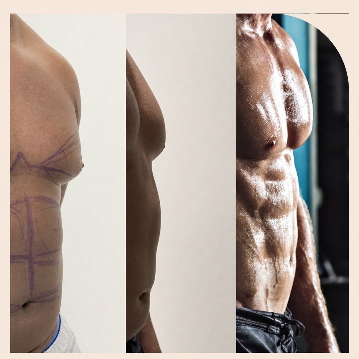 نتائج قبل وبعد جراحة التثدي في Dr. MED – تحسين شكل صدر الرجل