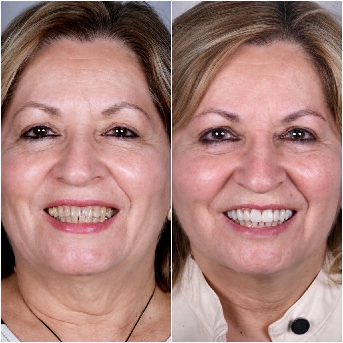 نتائج تبييض الأسنان قبل وبعد في Odontoliuzzi Dentistry and Health، ابتسامة أكثر إشراقًا