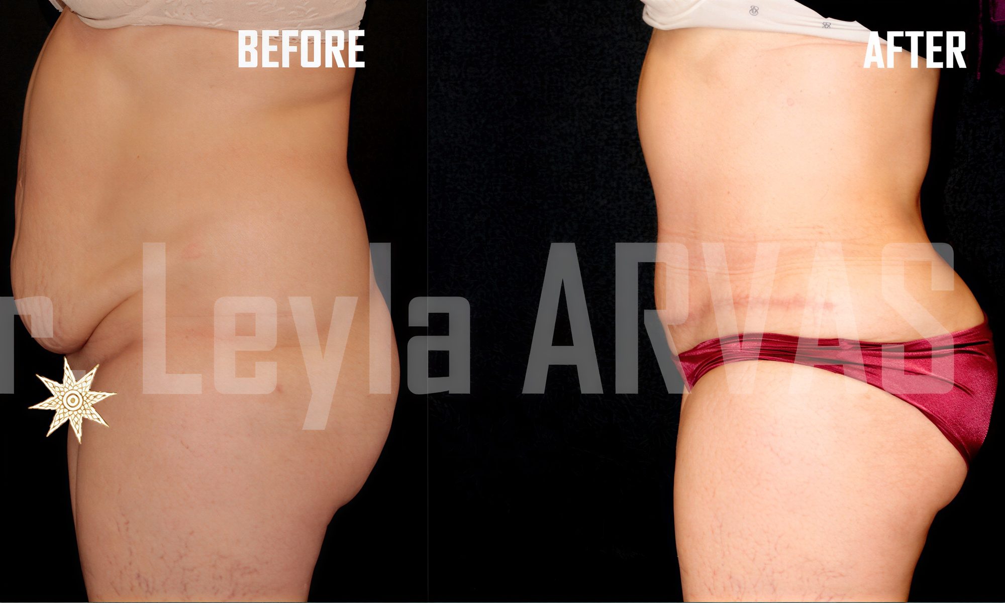 Resultado de liposucción abdominal antes y después en Quartz Hospital – abdomen más plano