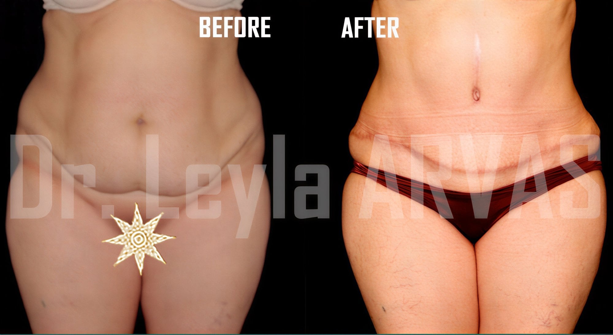 Resultados de liposucción abdominal antes y después en Quartz Hospital, contorno mejorado