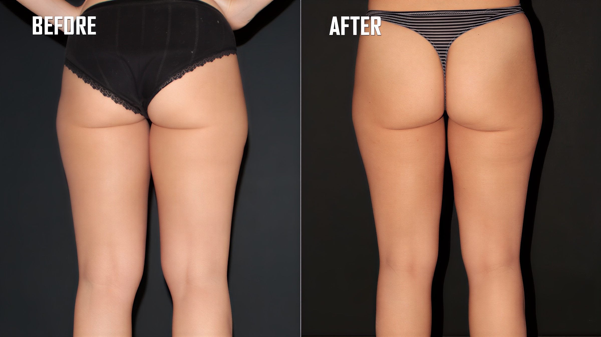 Resultados de Vaser liposucción en Quartz Hospital: mejor contorno de muslos y glúteos