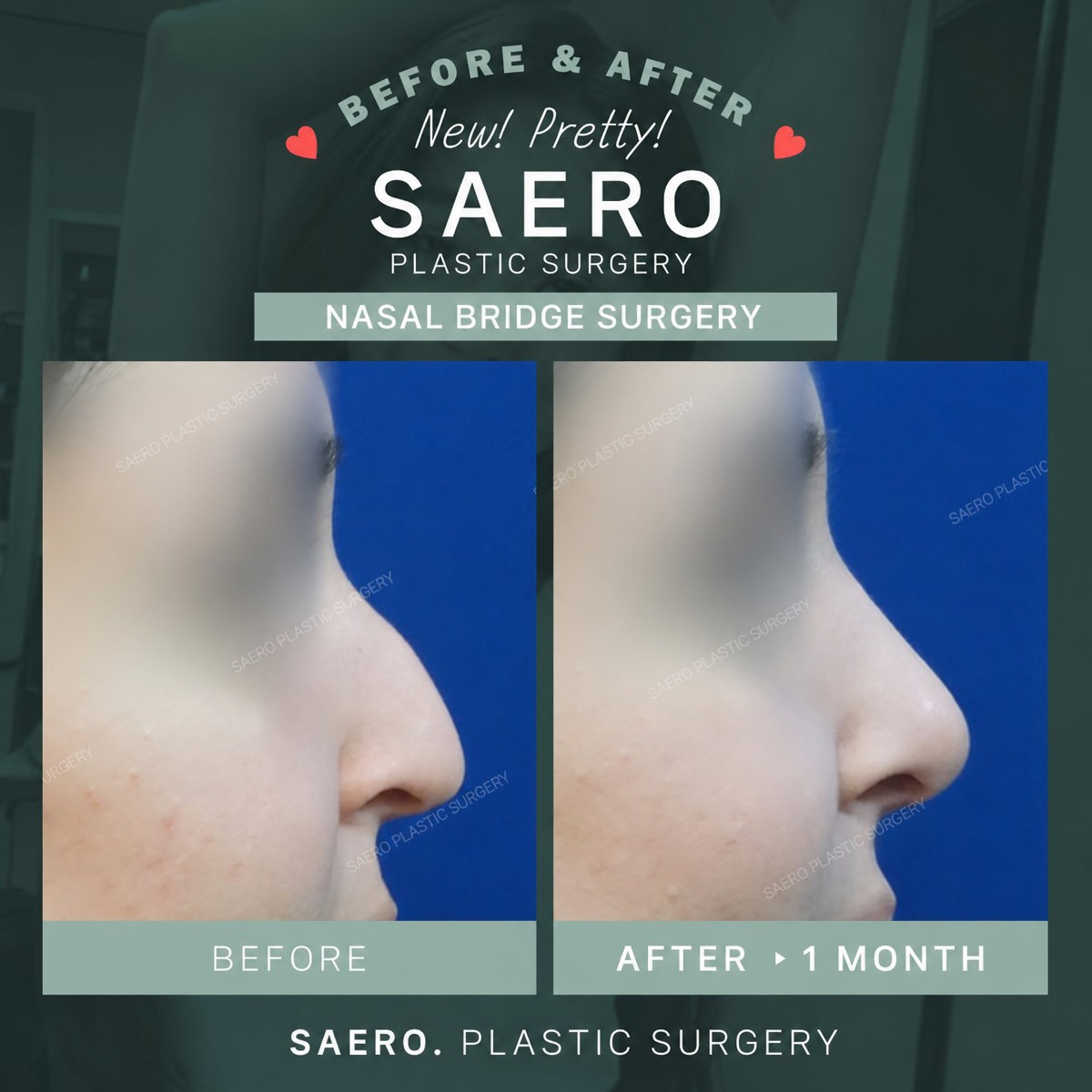 نتائج قبل وبعد جراحة جسر الأنف في SAERO Plastic Surgery، تحسين شكل الأنف