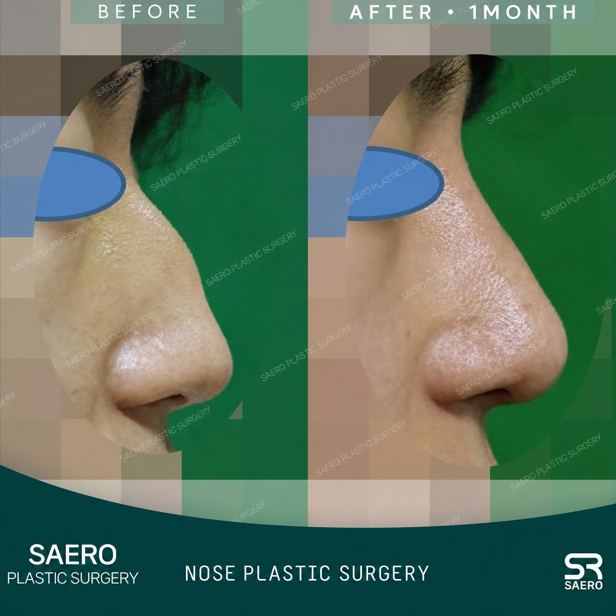 نتائج قبل وبعد عملية تجميل الأنف التصحيحية في SAERO Plastic Surgery، شكل أنف محسّن
