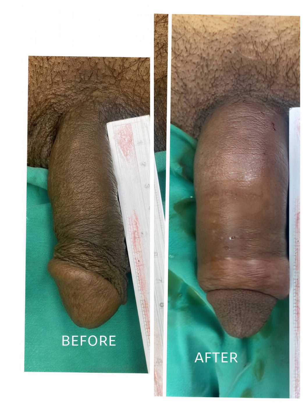 نتائج تكبير القضيب قبل وبعد في ID Clinic Bangkok، زيادة واضحة في السماكة
