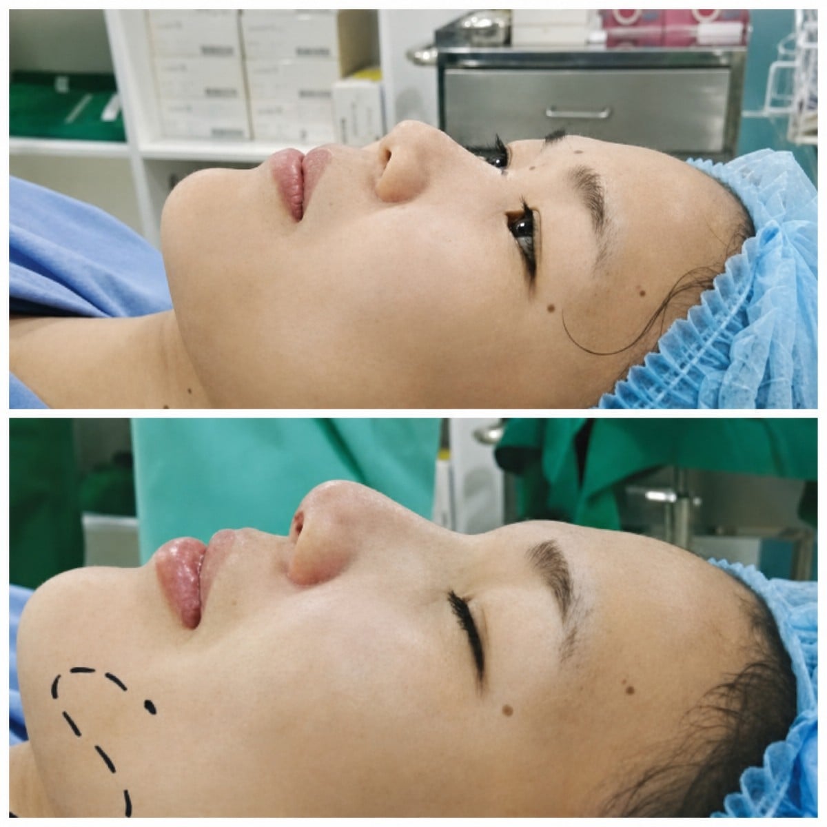 Resultados de rinoplastia antes y después en Janasia Clinic, mejora de la forma nasal