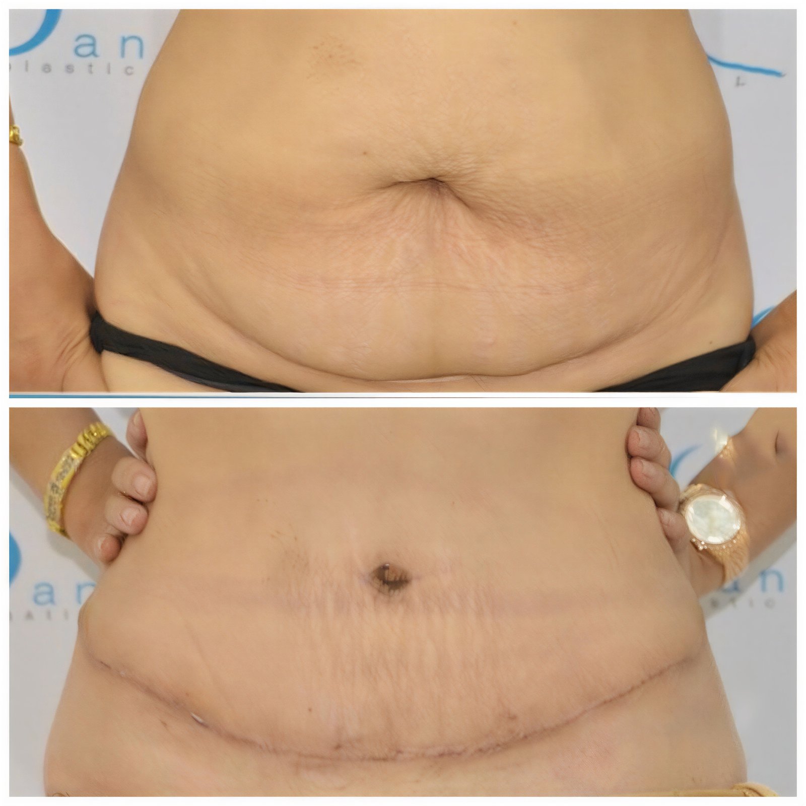 Resultados de abdominoplastia antes y después en Janasia Clinic, mejor contorno abdominal