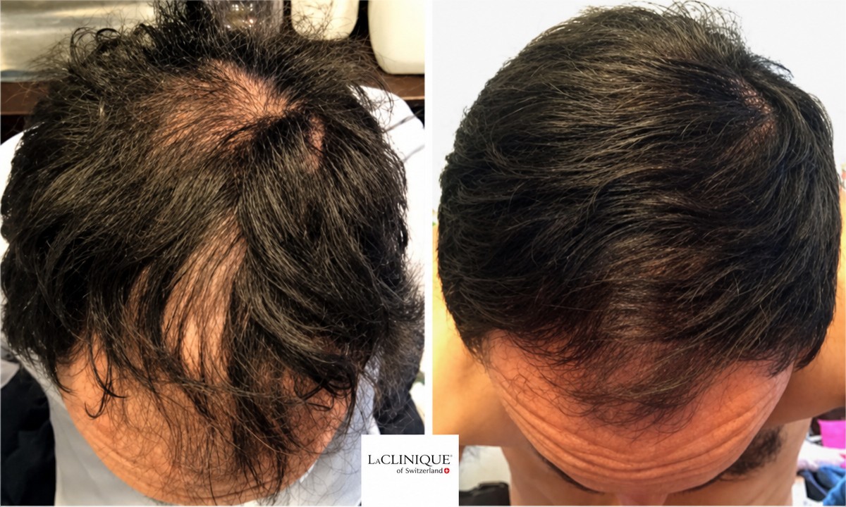 نتائج ميزوثيرابي الشعر قبل وبعد في LaCLINIQUE of Switzerland، كثافة شعر محسنة
