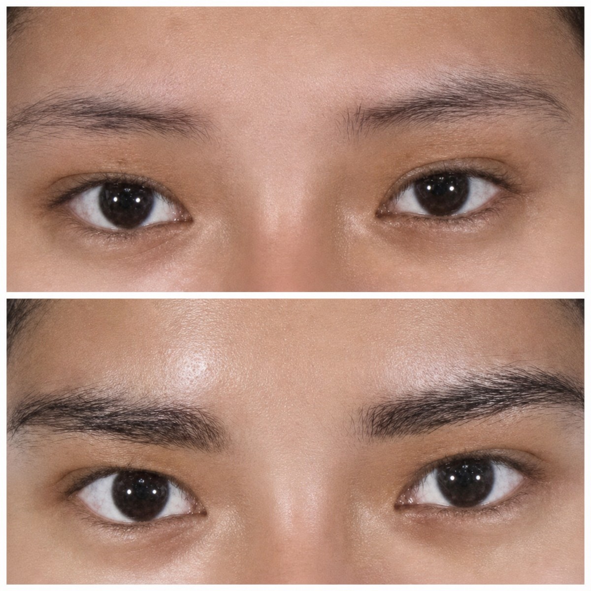 Resultados de trasplante de cejas antes y después en ID Clinic Bangkok, cejas más densas