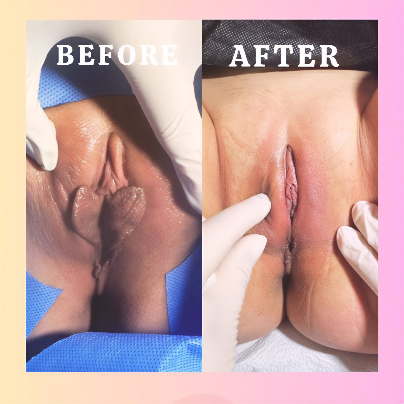 Resultados de vaginoplastia antes y después en Dr. İrem Yengel Clinic, apariencia mejorada