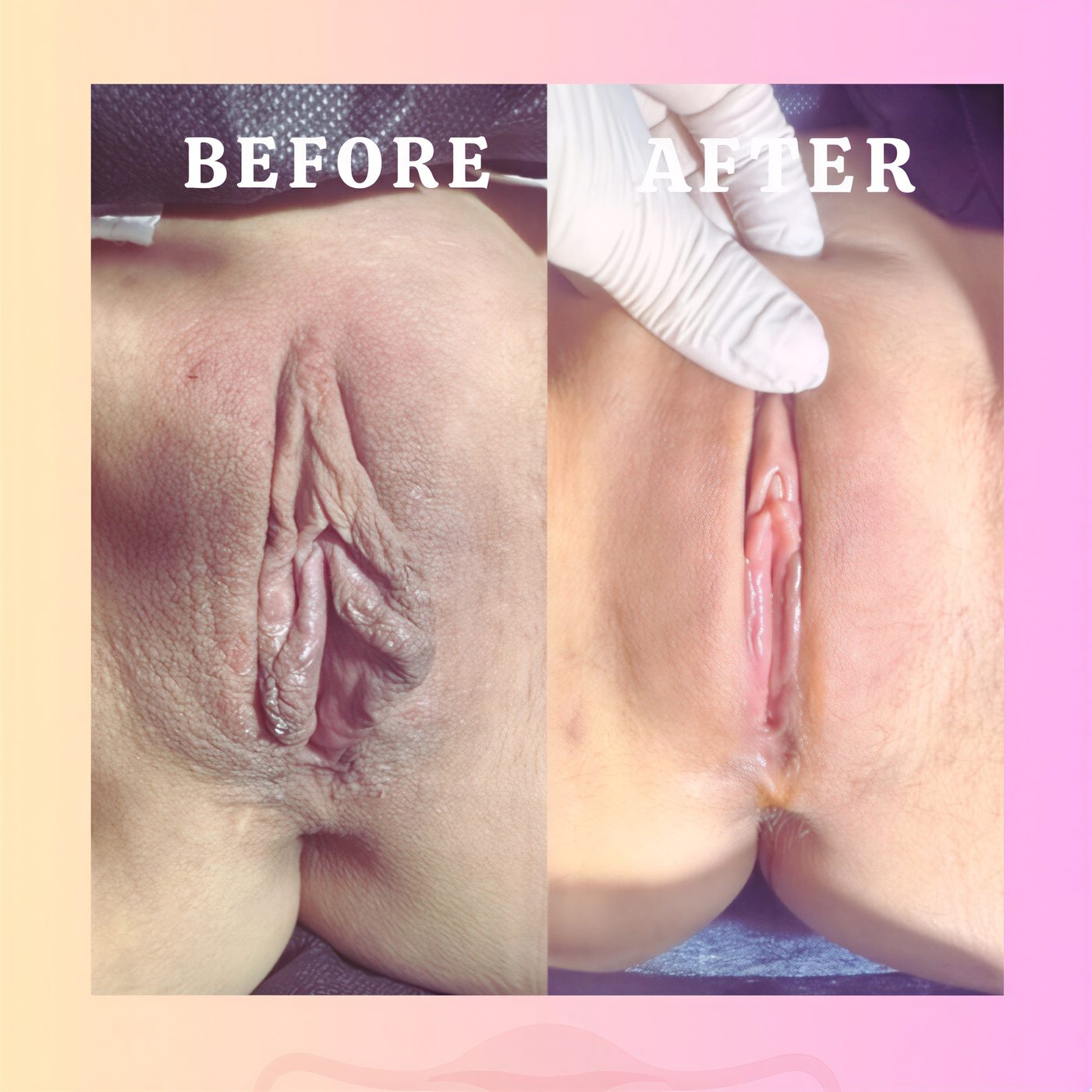 نتائج قبل وبعد عملية تجميل الشفرين في عيادة د. إيرم ينجل، مظهر محسن للشفرين