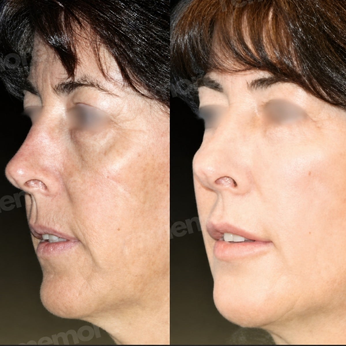 Resultados de blefaroplastia superior antes y después en Memorial Bahçelievler Hospital, rejuvenecimiento