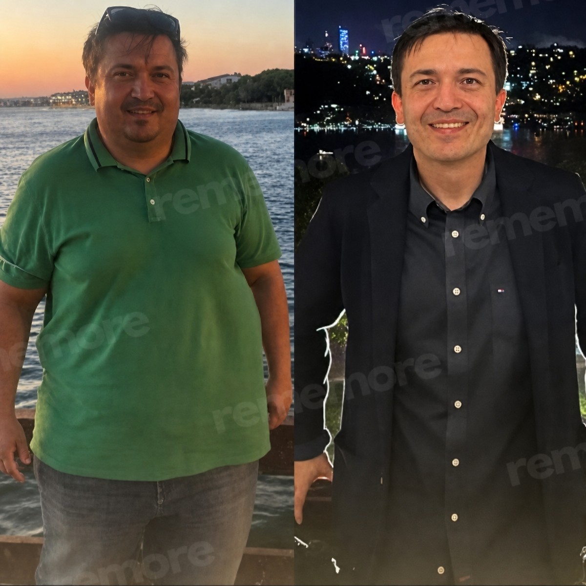 نتائج قبل وبعد بالون المعدة في مستشفى ميموريال أتاشهير، فقدان وزن ملحوظ
