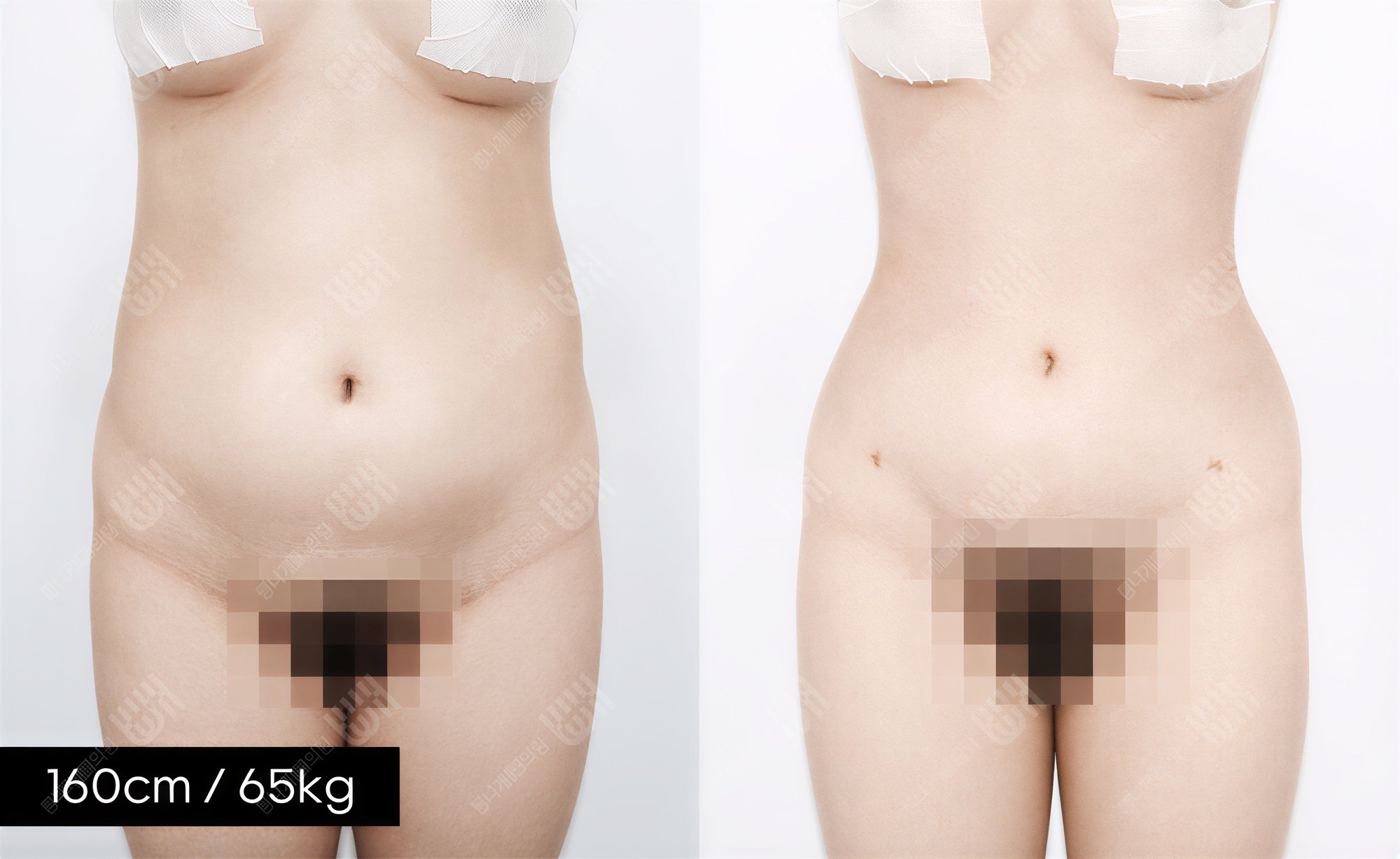 Resultados de liposucción abdominal antes y después en Bbae Clinic, mejora del contorno