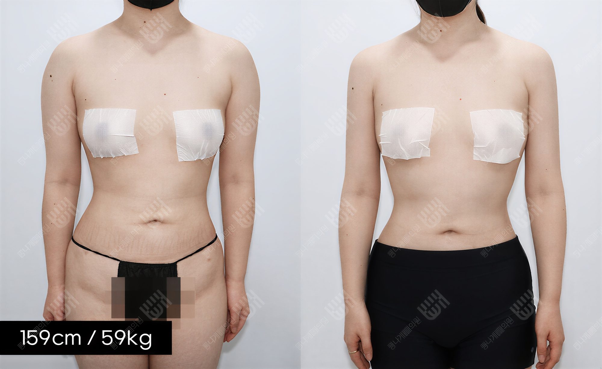 Resultados de liposucción de brazos en Bbae Clinic, mejora visible del contorno de brazos